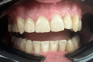 04 caso rea implante zirconio