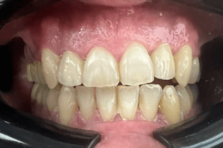 05 caso rea implante zirconio