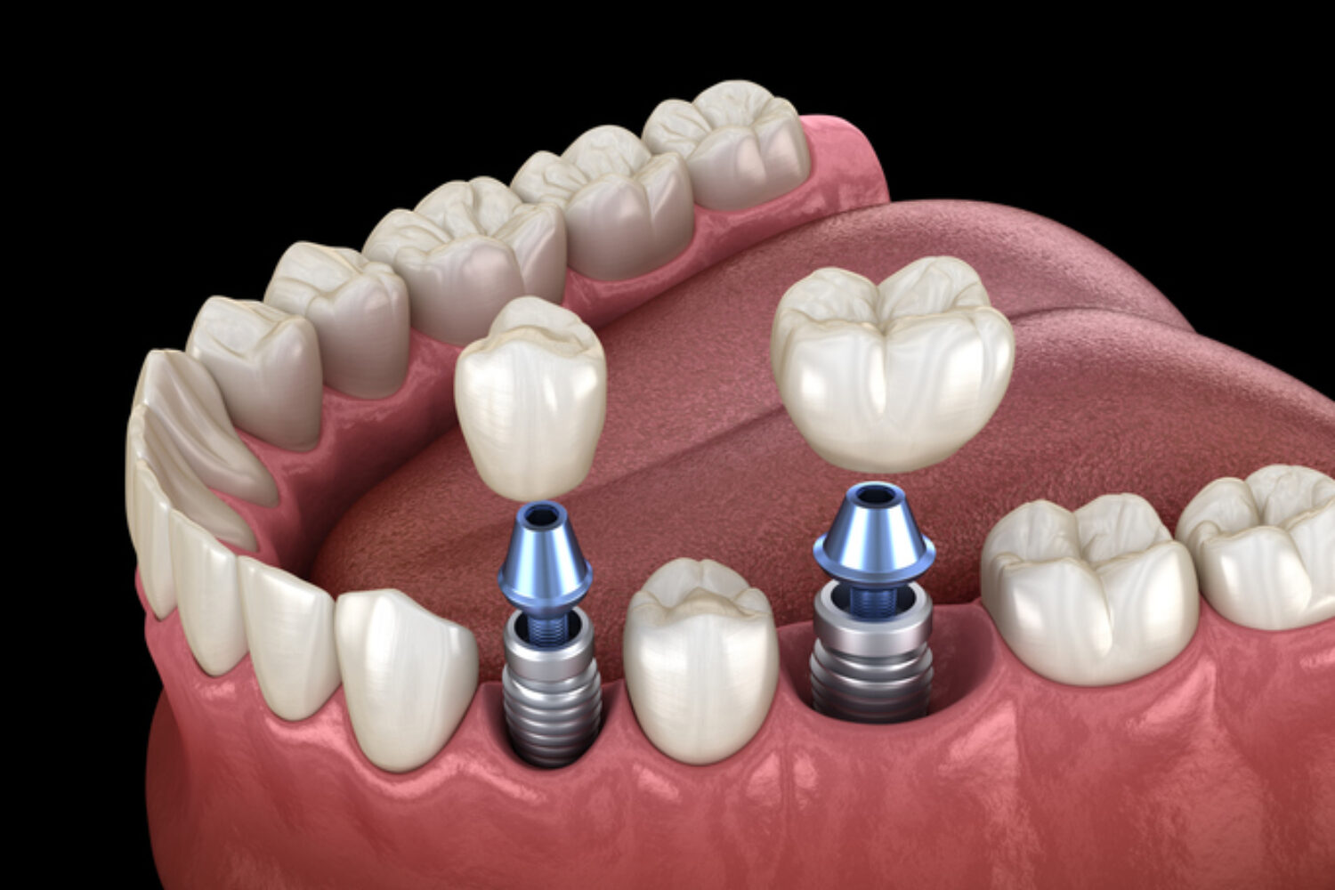 cirugía guiada en implantes dentales