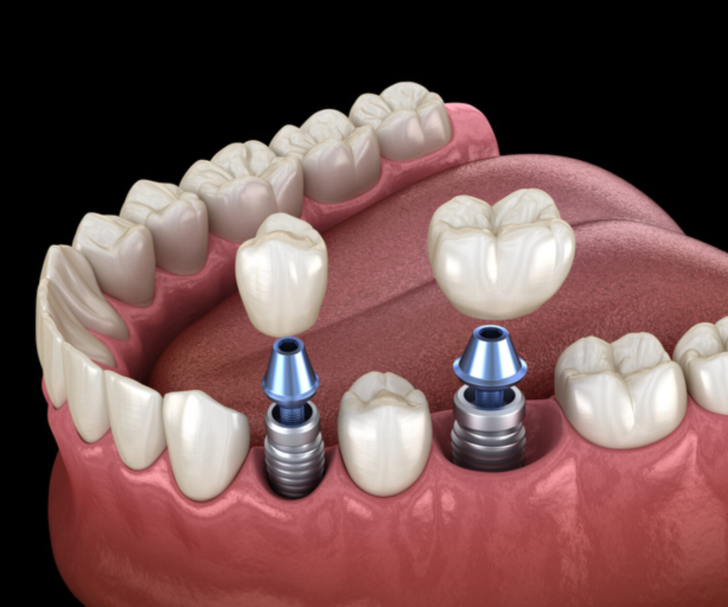 cirugía guiada en implantes dentales
