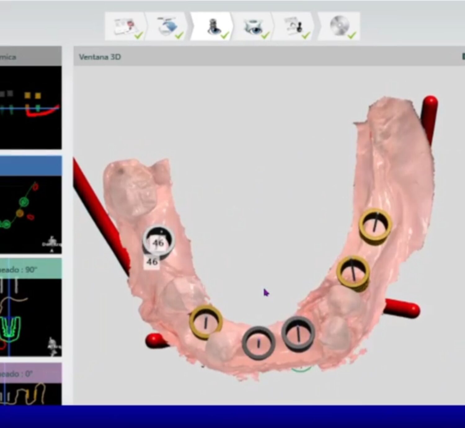 cirugía guiada en implantes dentales