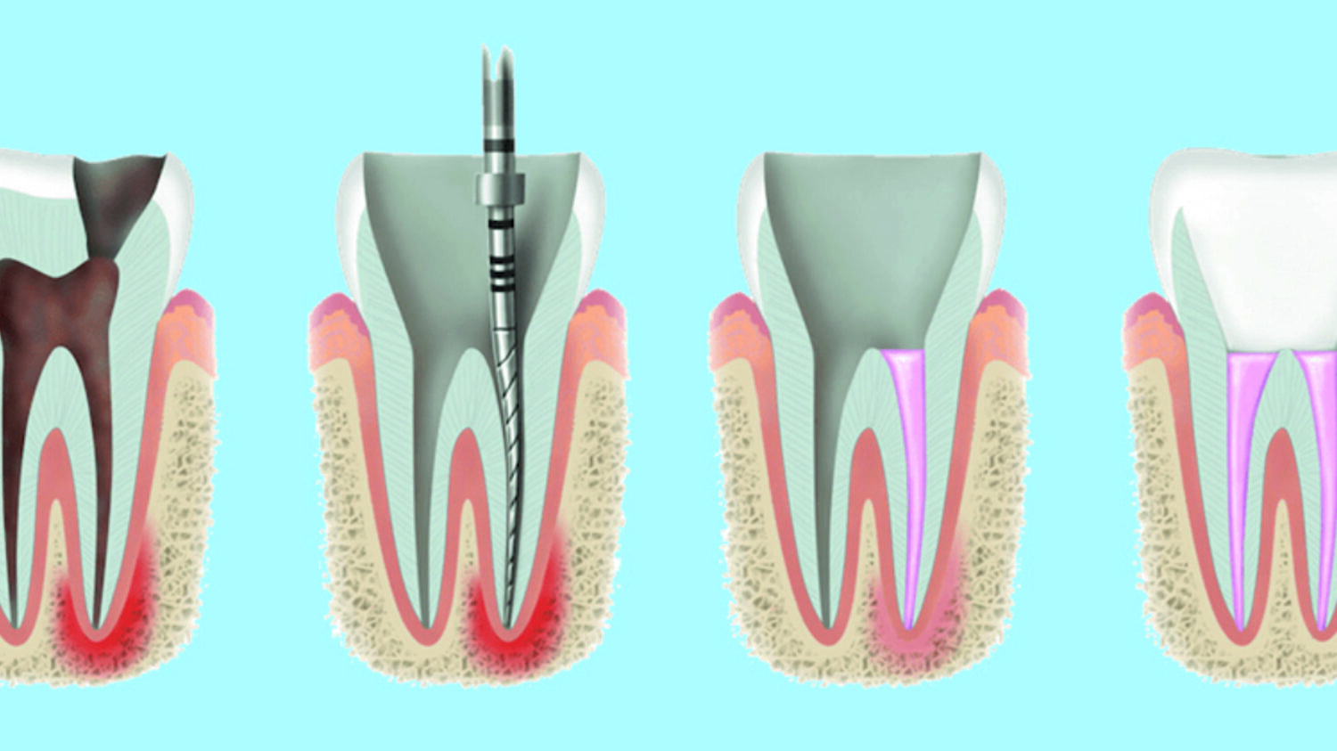 endodoncia rotatoria