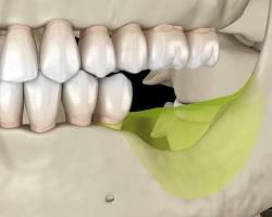 Cirugía Guiada en Implantes Dentales ¿Siempre es necesaria? 1 escasa calidad ósea