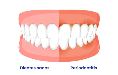 dientes sanos vs periodontitis