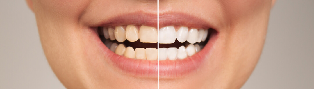 resultados de un blanqueamiento dental profesional