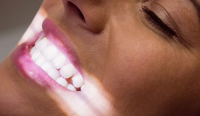 blanqueamiento dental