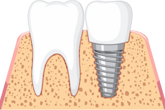 implantes dentales con poco hueso
