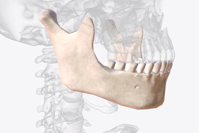 injerto óseo para implantes dentales con poco hueso
