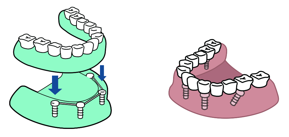 ¿Qué es una sobredentadura sobre cuatro implantes? 1 sobredentadura de cuatro implantes
