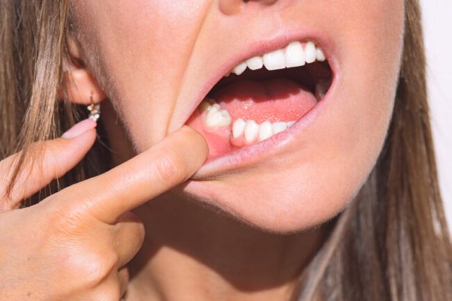 Me ha salido un bulto en la encía ¿qué puede ser? 2 bulto en la encía - fibroma