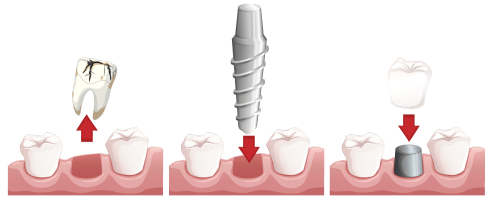 proceso implantes carga inmediata
